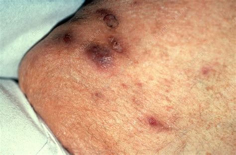 Boils on Patient's Thigh - Stock Image - C022/2128 - Science Photo Library