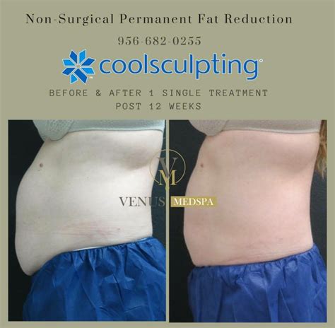 Liposuction Alternatives 2025 - Carlo M. Songer