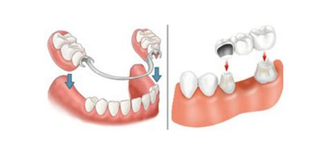 Bridge or Partial Denture? Which Is Best For Me?