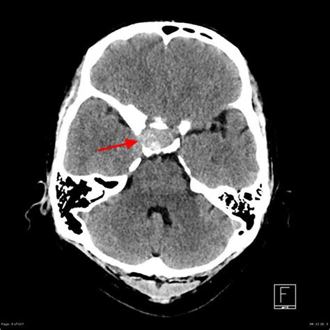 Pituitary Tumor - Signs, Symptoms, Diagnosis, MRI, Surgery & Treatment