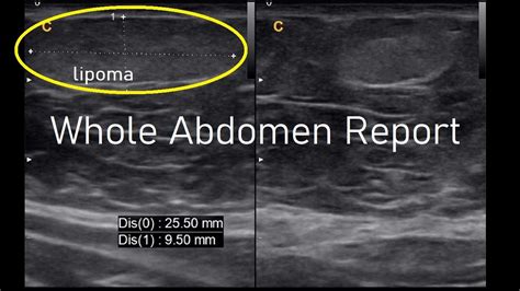 Small lipoma epigastric region | Ultrasound | Report | Amader hospital | Ultrasonography report ...