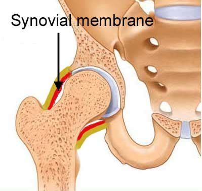 Transient hip synovitis - Hip and Knee clinic