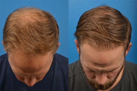 Hair Restoration Photos | Melbourne, FL | Patient 6388