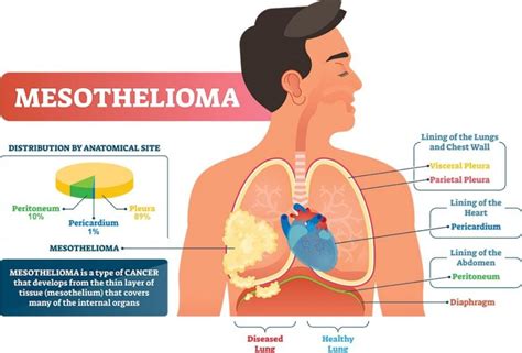 Causes and symptoms of mesothelioma cancer - News Corner