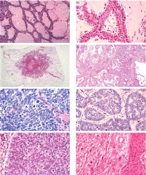 Small Cell Lung Cancer Histology