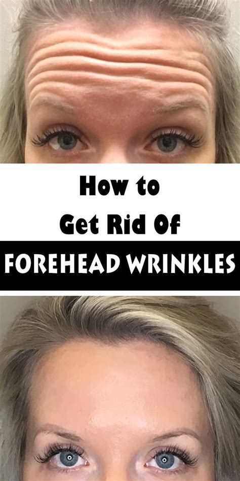 How To Get Rid Of Forehead Wrinkles Without Botox | Healthcare Topic