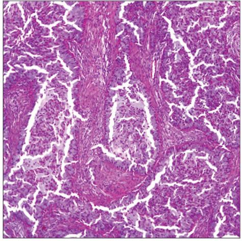 Acinic Cell Carcinoma | Basicmedical Key