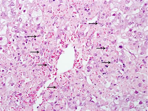 Acute Hepatic Necrosis (2023)