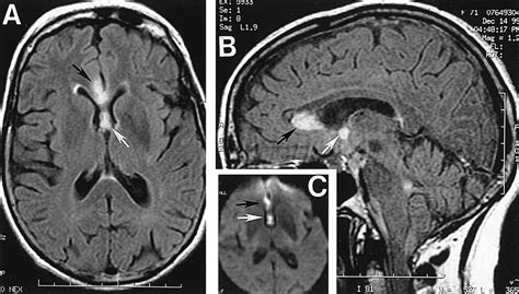 Amnesia due to Fornix Infarction | Stroke