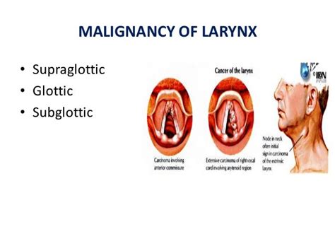 Larynx