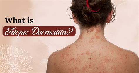 What is Atopic Dermatitis Treatment, Symptoms and Causes?