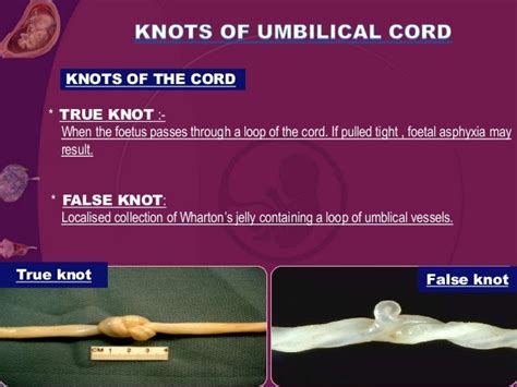 Umblical cord presentation