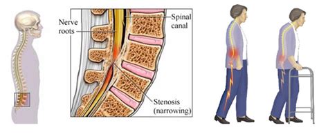 Spinal Stenosis Surgery Risks precianan
