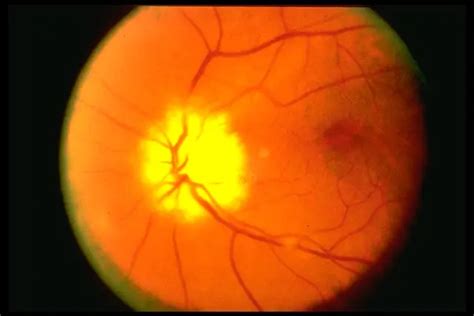 Ischemic optic neuropathy - American Academy of Ophthalmology