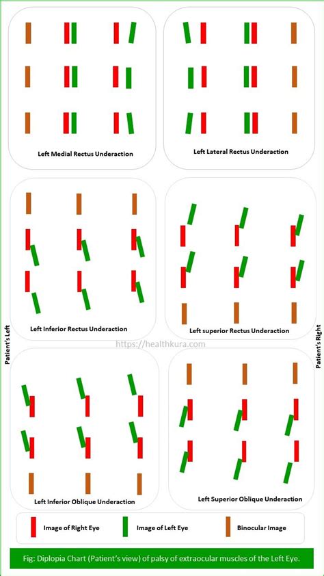 Diplopia Charting: Common Method of Double Vision Test | Health Kura ...