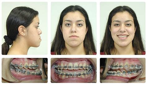 Underbite Before And After Braces