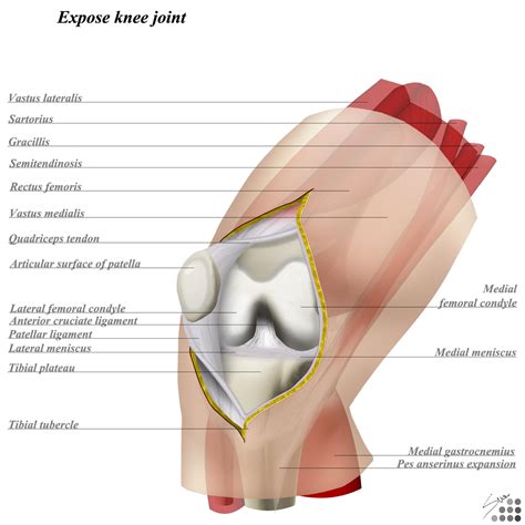 Knee Medial Parapatellar Approach - Approaches - Orthobullets