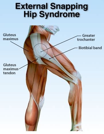 Snapping Hip Syndrome - Robert Howells