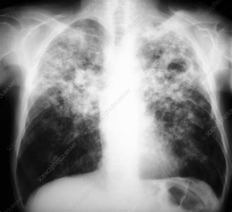 Tuberculosis, X-ray - Stock Image - M270/0273 - Science Photo Library