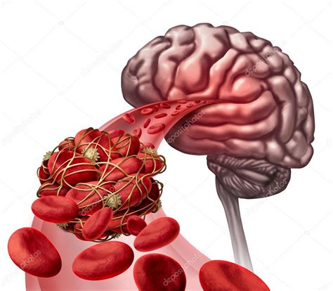 Brain Blood Clot Stock Photo by ©lightsource 106619020