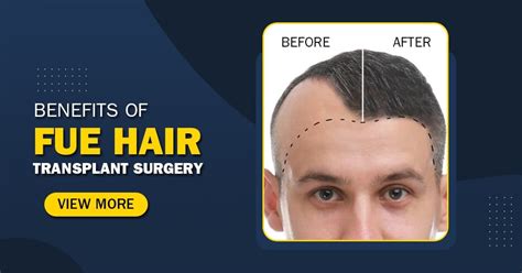 Benefits of FUE Hair Transplant Surgery - Marvelous Aesthetics