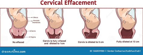 Cervical Effacement And Dilation During Delivery. Cervix, Labor Or ...