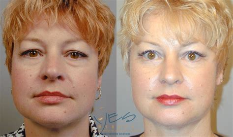 Lower Eyelid Blepharoplasty Before & After Photos Patient 43 | Vancouver, BC | YES Medspa ...