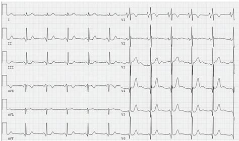 Twelve-lead ECG showing P mitrale in lead V 1 . | Download Scientific Diagram