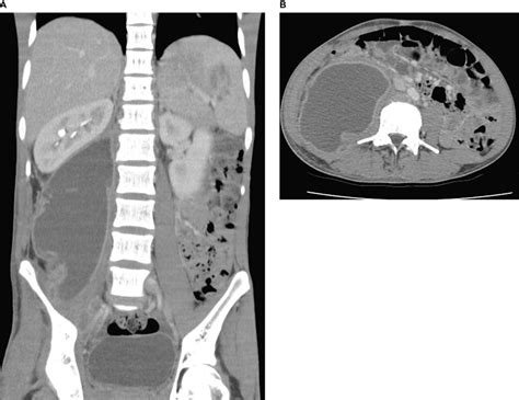 Psoas Abscess X Ray