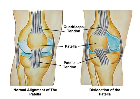 Patella Dislocations - Rural Physio at Your Doorstep