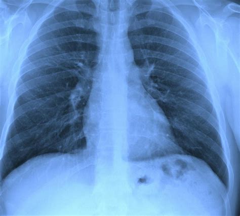 What Causes Scar Tissue in the Lungs? (with pictures)