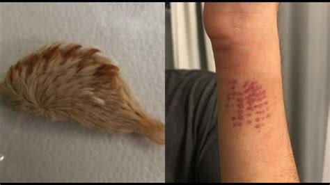 Teen hospitalized after touching venomous caterpillar | 10tv.com