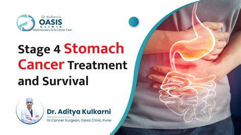 Stage 4 Stomach Cancer Treatment and Survival - An Tâm