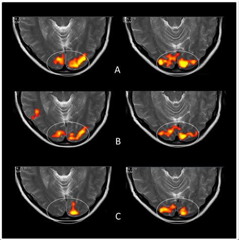 (Shokida et al): Axial views of the posterior anatomical (Occipital ...