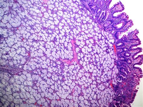 Pathology Outlines - Brunner gland nodule