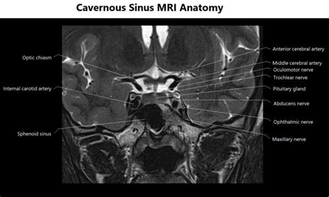 Cavernous Sinus MRI | MRI Cavernous Sinus Protocol and Planning