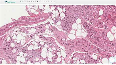 Angiolipoma - Histopathology - YouTube