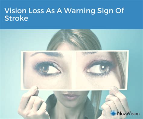 Vision Loss As A Warning Sign Of Stroke – NovaVision