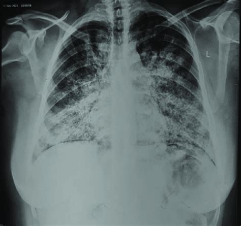 A 36-year-old lady with pulmonary alveolar proteinosis who presented ...