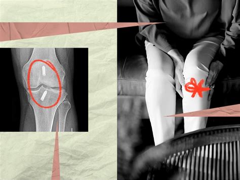 What are some symptoms of ACL screw pain?