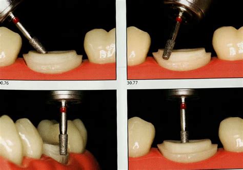 Endocrown .. part 1 | Dental Esthetics