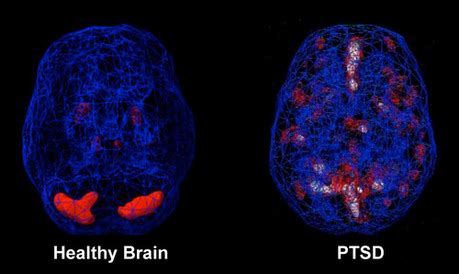 PTSD & the Brain - PTSD