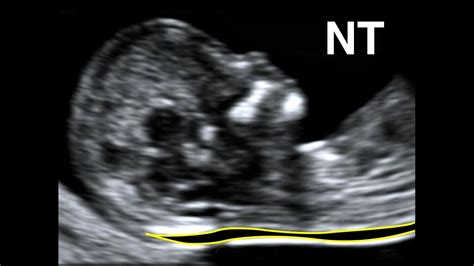 How to perform Nuchal Translucency Scan - YouTube