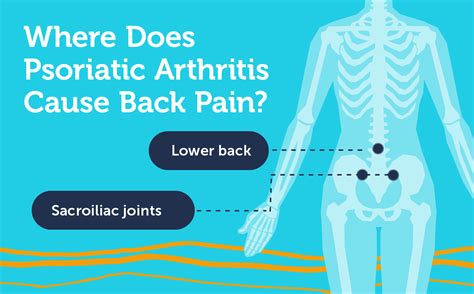 Psoriatic Arthritis Signs And Symptoms