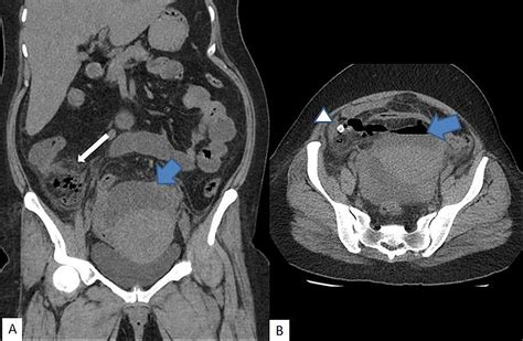 Cureus | Accuracy of Computed Tomography in Differentiating Perforated from Nonperforated ...