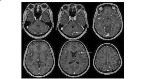 Maternal MRI showing small ring-enhancing lesions in both cerebral and... | Download Scientific ...