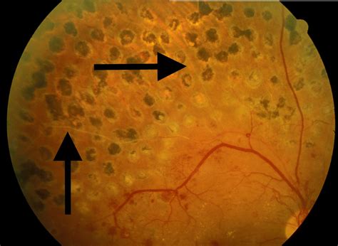 View of laser scars - Endotext