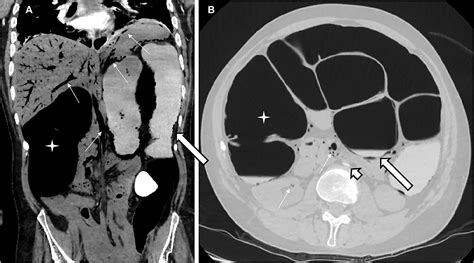 Pneumatosis intestinalis with portal, mesenteric and renal gas due to colonic pseudo-obstruction