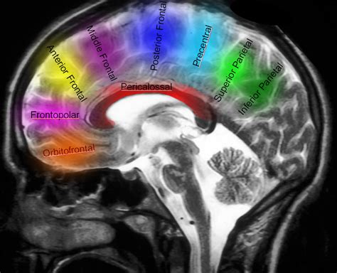 Anterior Cerebral Artery | neuroangio.org