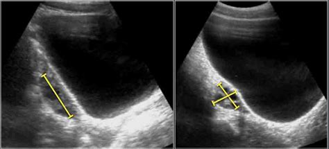 The Radiology Assistant : Normal Values - Ultrasound